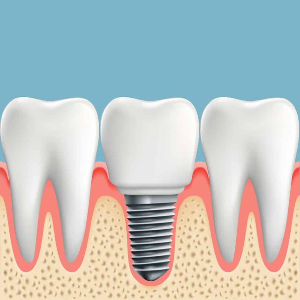 a dental implant