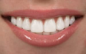 Woman smiling with veneers