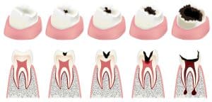 An illustration of the stages of tooth decay