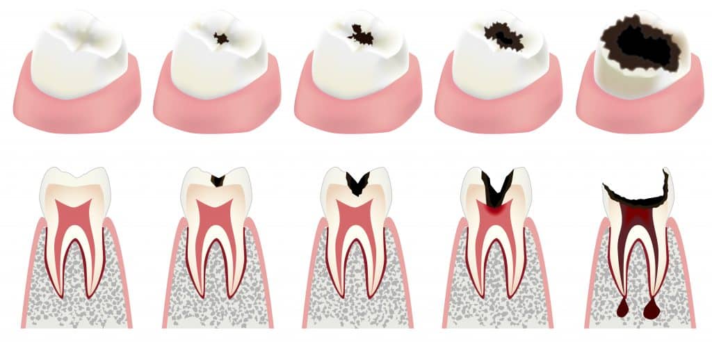 Are You At Risk For Tooth Decay An illustration of the stages of tooth decay