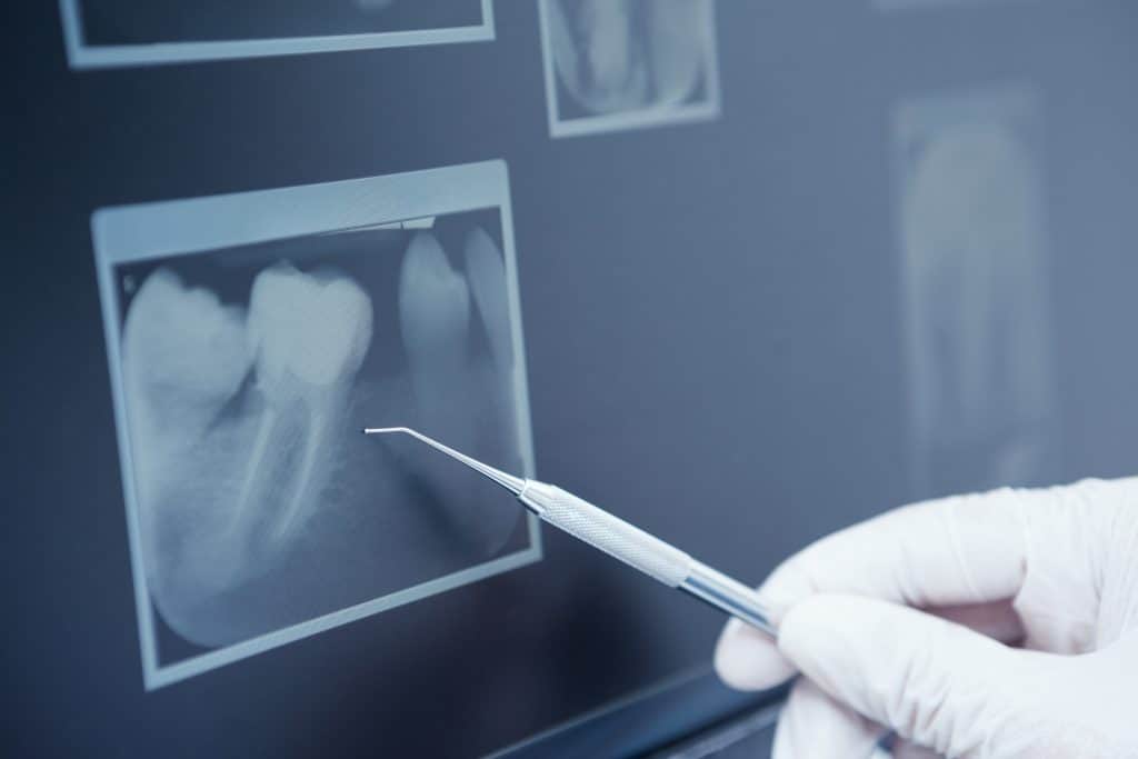 Gloved hand holding dental tool to teeth x-rays