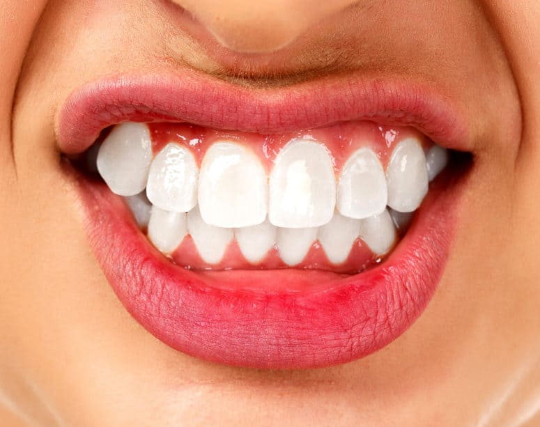 Bruxism Woman grinding her teeth