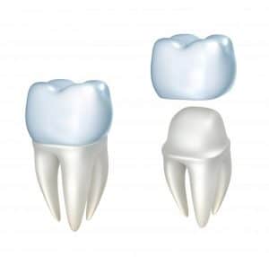 illustration of dental crown