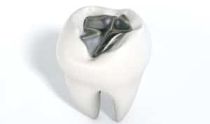 A metal cavity filling on a single molar on an isolated background
