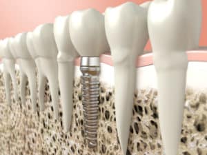 Bone Grafting for Dental Implants