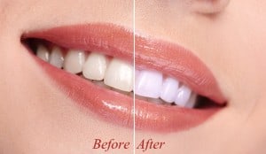 Woman smiling with teeth whitening before and after close-up