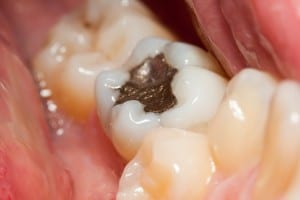 Metal amalgam fillings are silver and require more tooth removed