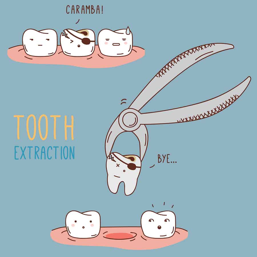 Tooth Extraction Illustration An Illustration of Tooth Extraction
