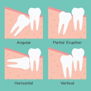 four types of an impacted wisdom tooth