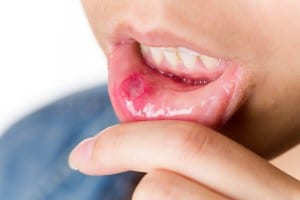 oral cancer screenings can save lives