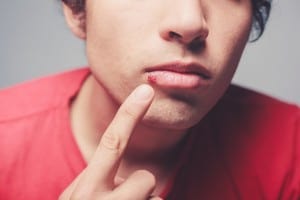 Young man pointing at a cold sore needing treatment 