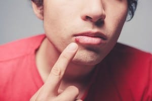 Young man pointing at a cold sore needing treatment