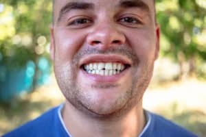 man with chipped front tooth