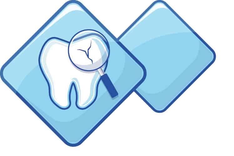 Craze Lines Are Not Cracks a tooth with a crack in it to show that it is not craze lines