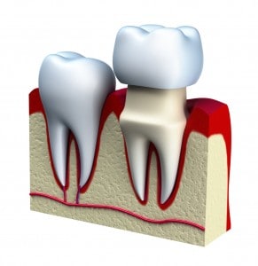 Idaho Falls dentist company explains dental crowns