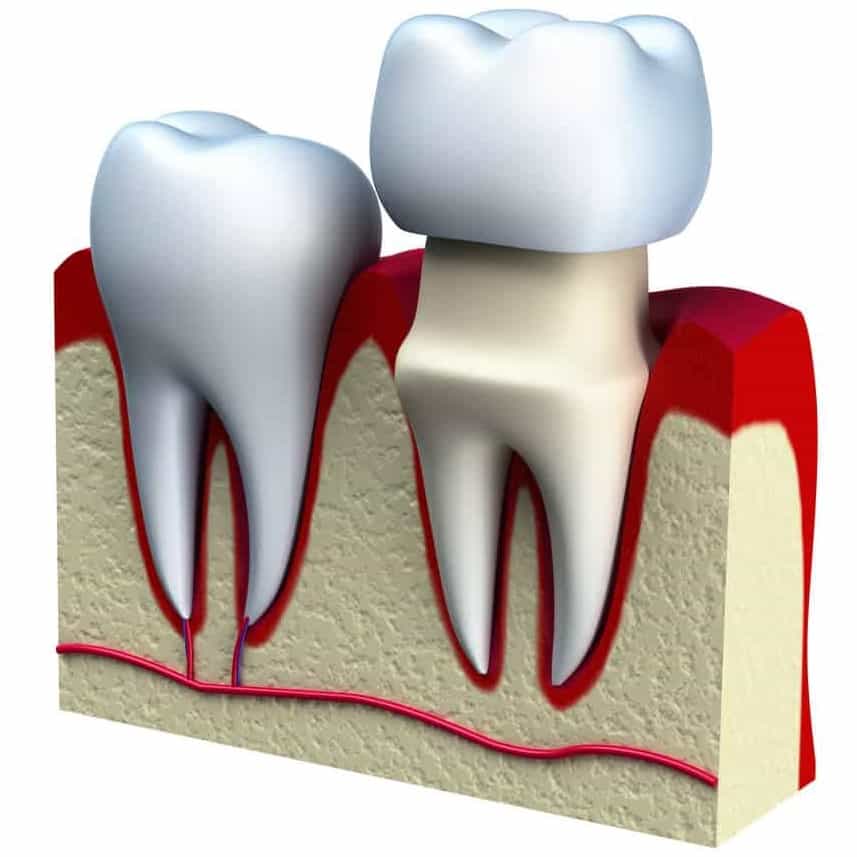Dental Crowns Idaho Falls Dentist