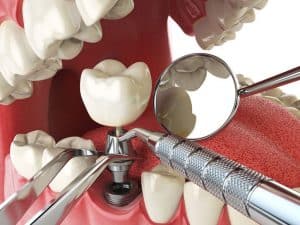 illustration of dental implant process