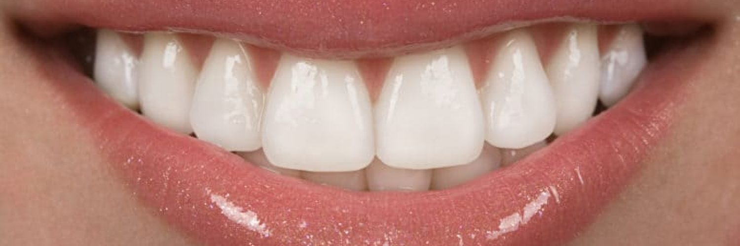 Woman smiling with veneers