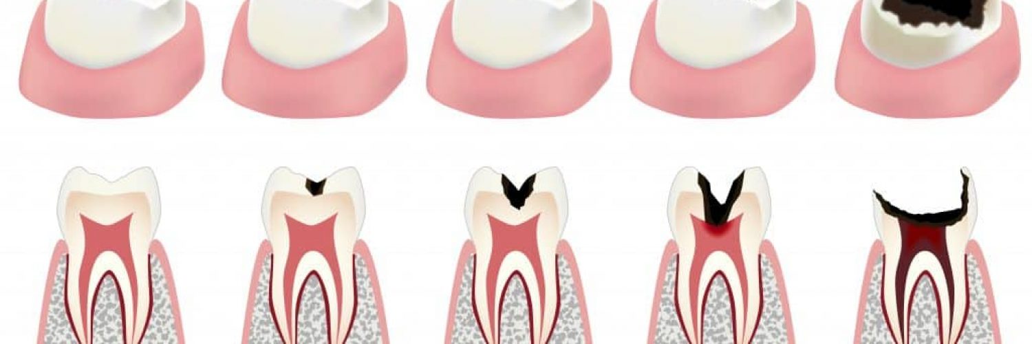 An illustration of the stages of tooth decay