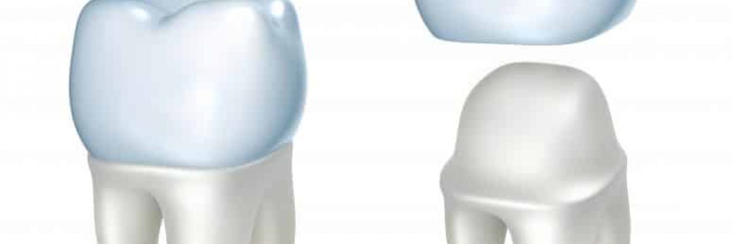 illustration of dental crown