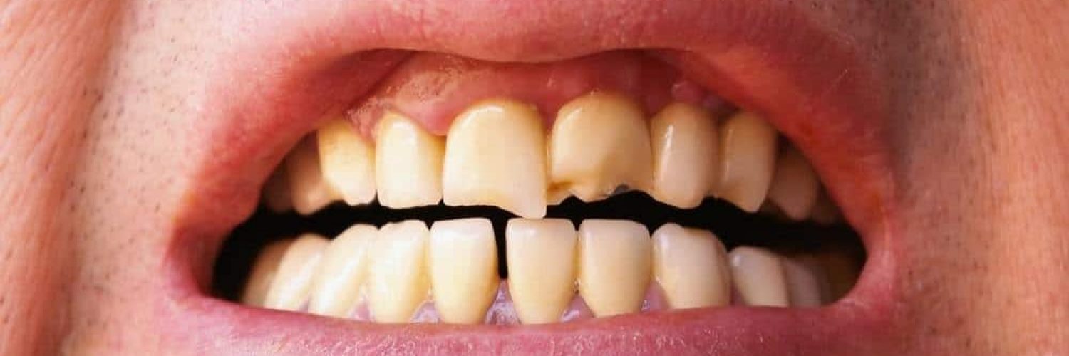 Broken Tooth