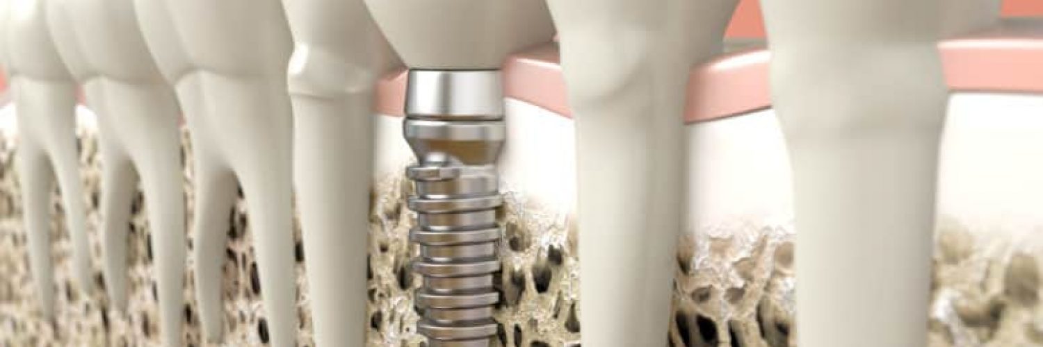 Bone Grafting for Dental Implants