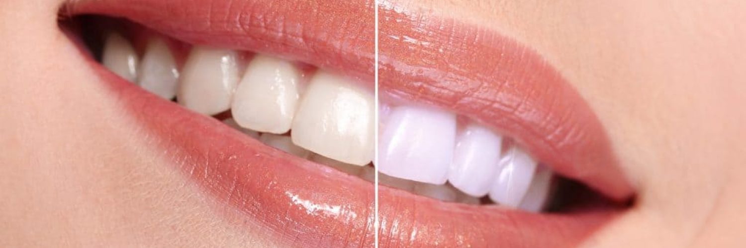 Woman smiling with teeth whitening before and after close-up