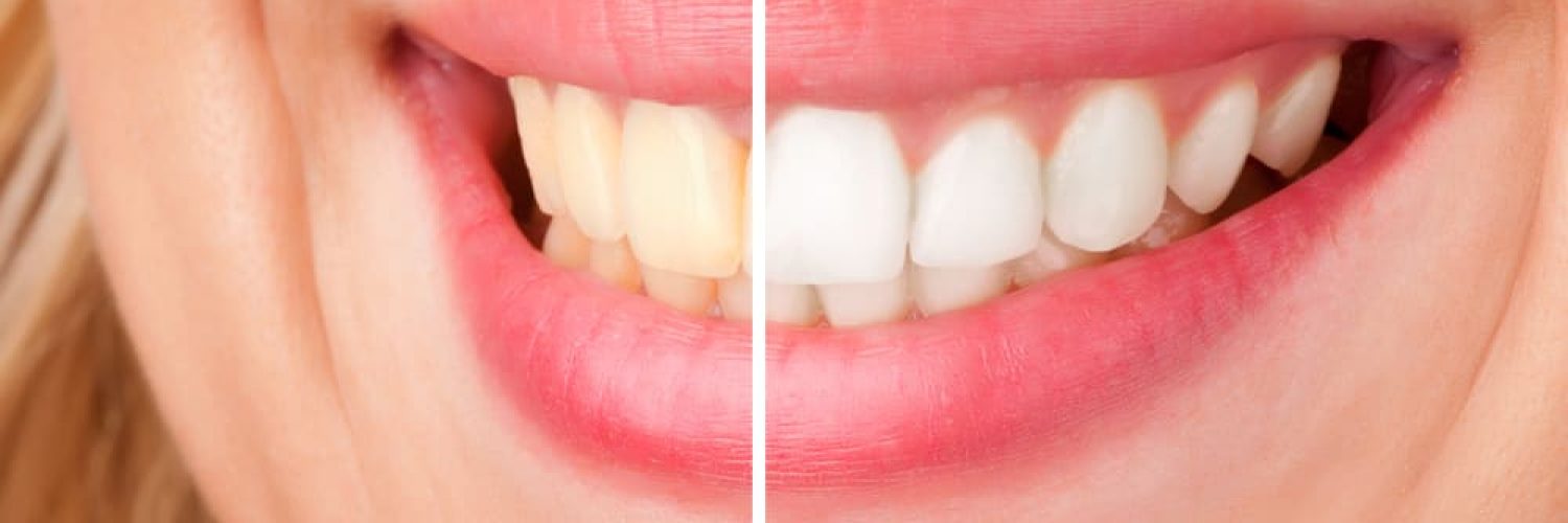 Before and after of a dental whitening procedure