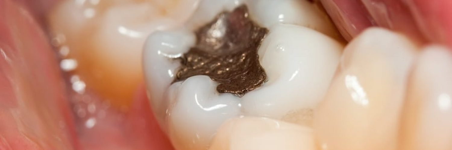 Metal amalgam fillings are silver and require more tooth removed