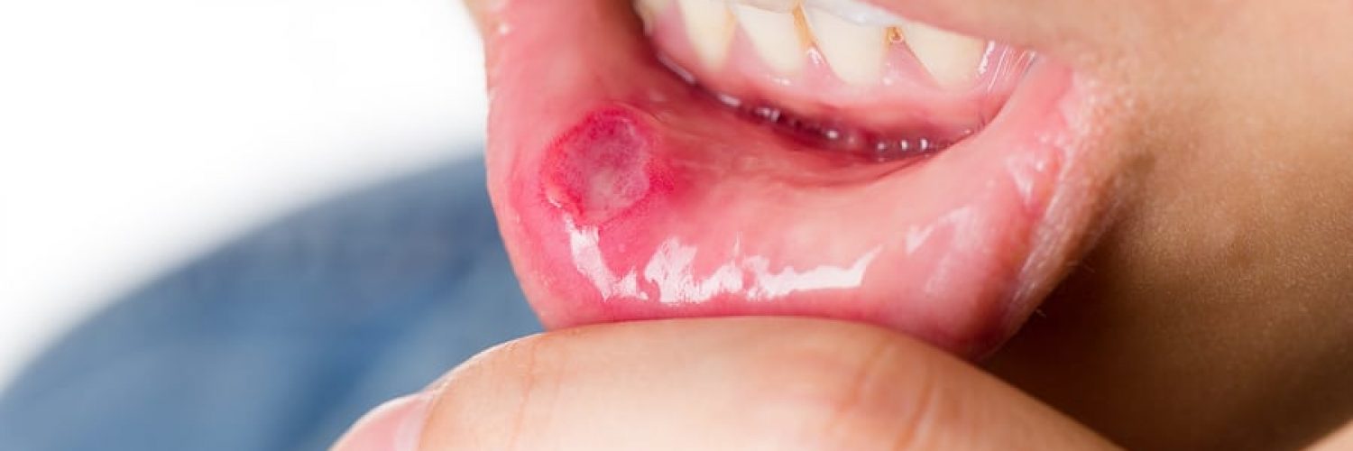oral cancer screenings can save lives