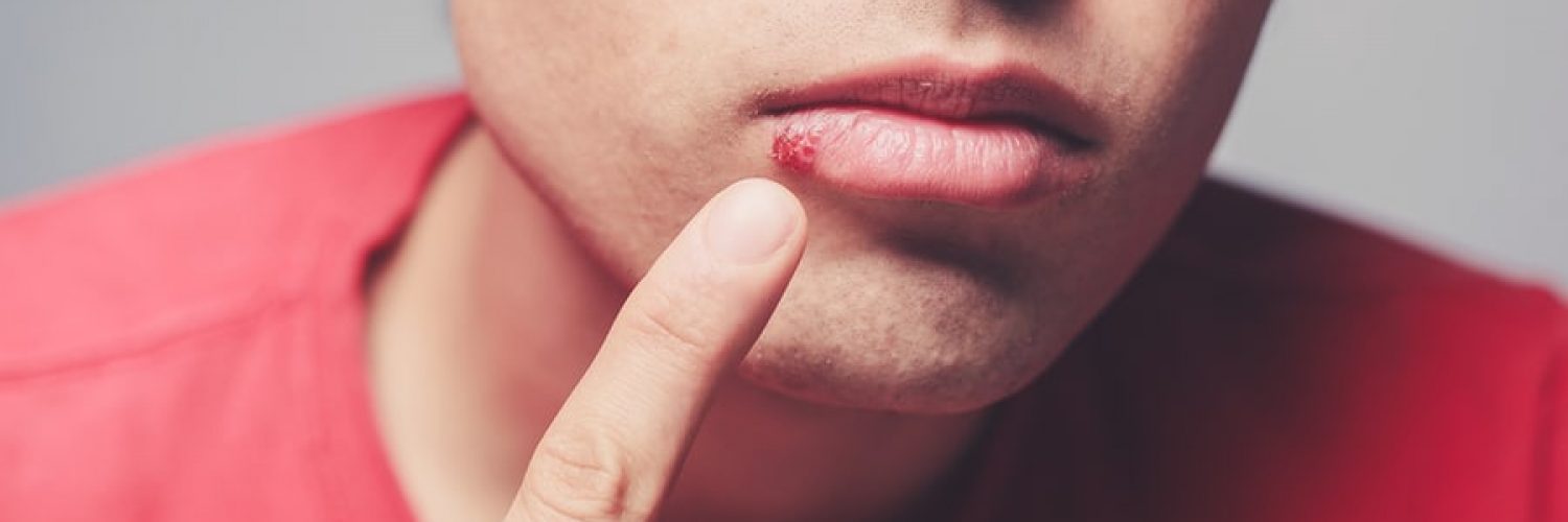 Young man pointing at a cold sore needing treatment