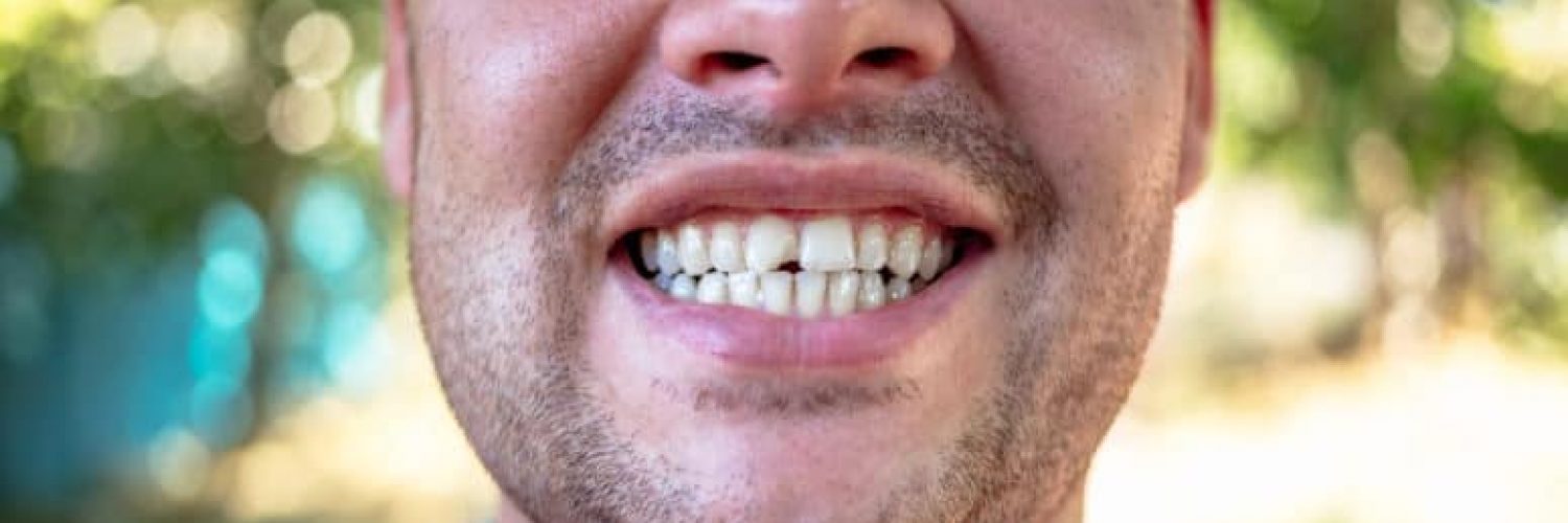 man with chipped front tooth