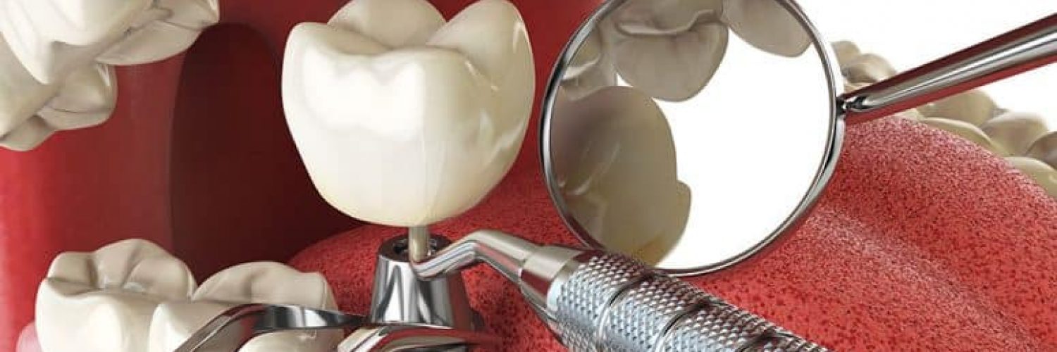 illustration of dental implant process