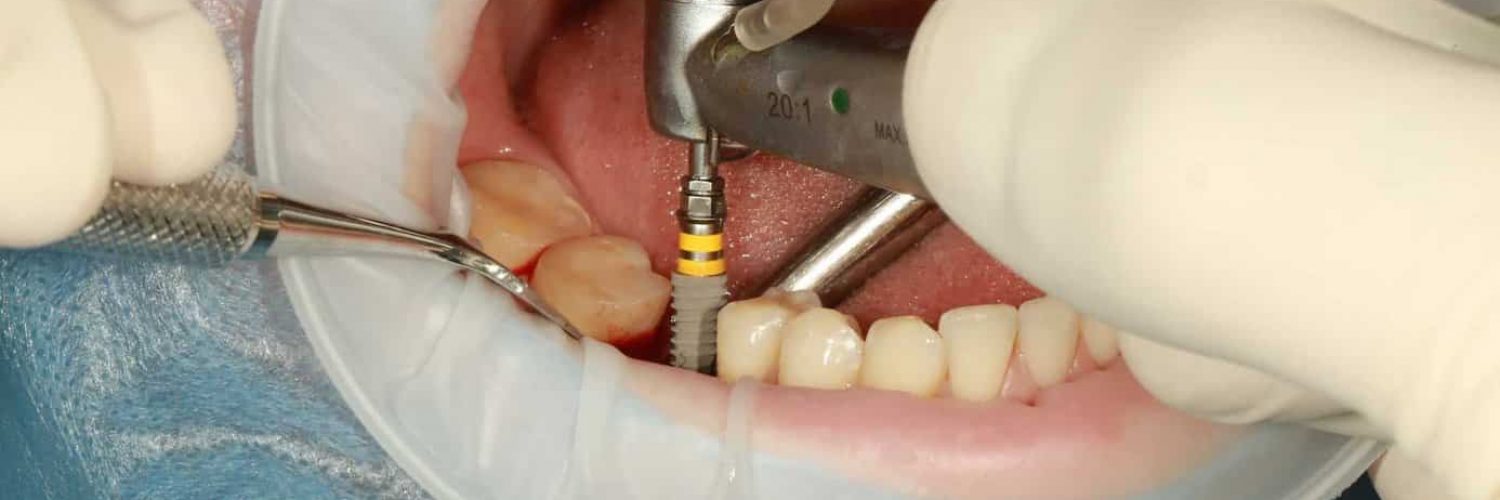 Dental implants