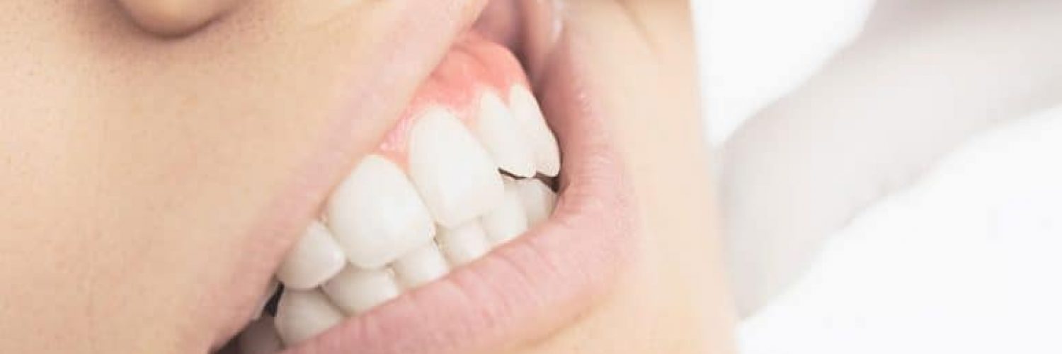 Woman having her gums looked at to determine gum reshaping