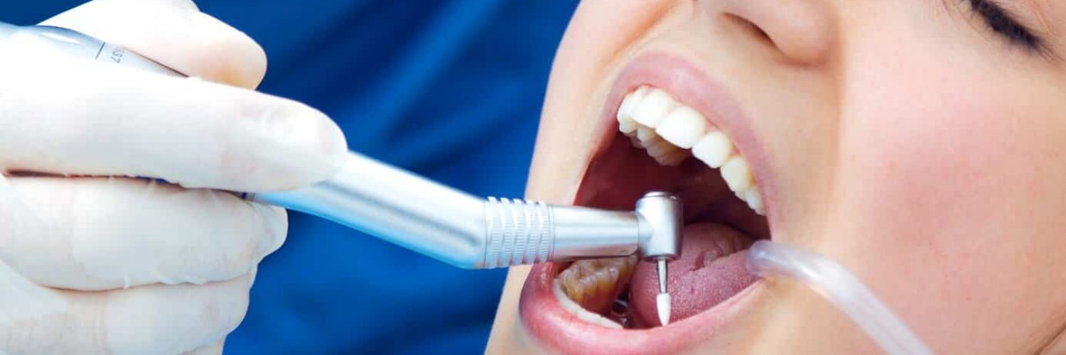 Patient Undergoing White Filling Treatment, idaho falls, local dentist near me, dental