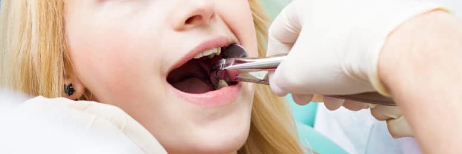 woman receiving tooth extraction from dentist