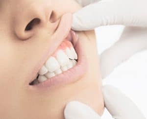 Woman having her gums looked at to determine gum reshaping