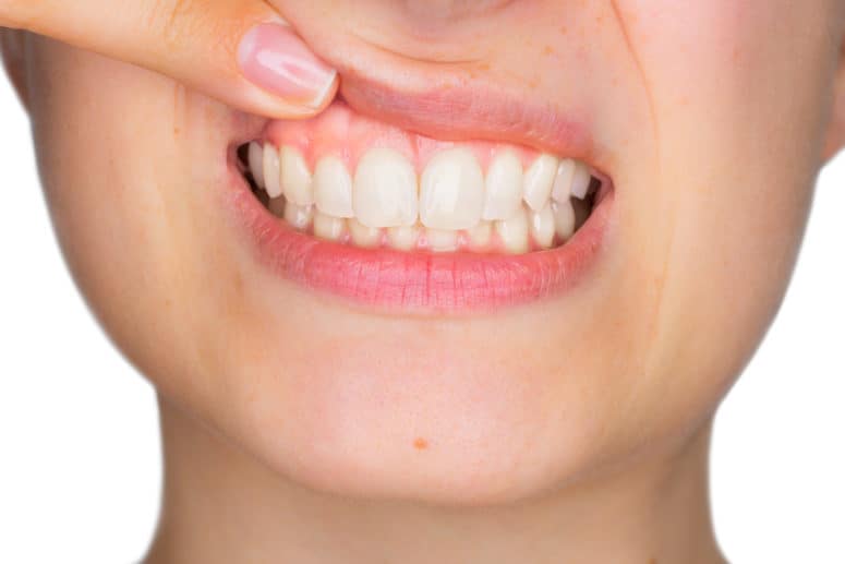 Healthy Gums