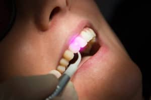 woman receiving dental laser cleaning