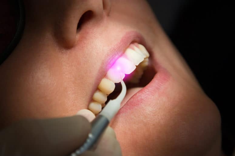Dental Laser Cleaning