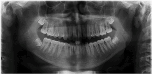 panographic-dental-x-ray-by-your-idaho-falls-dentist