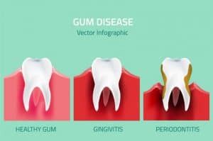 periodontitis