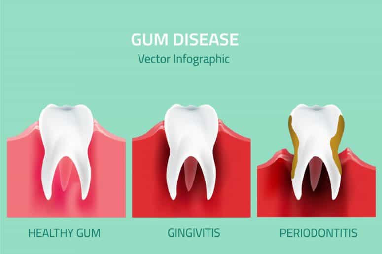 periodontitis_blog_post_image periodontitis