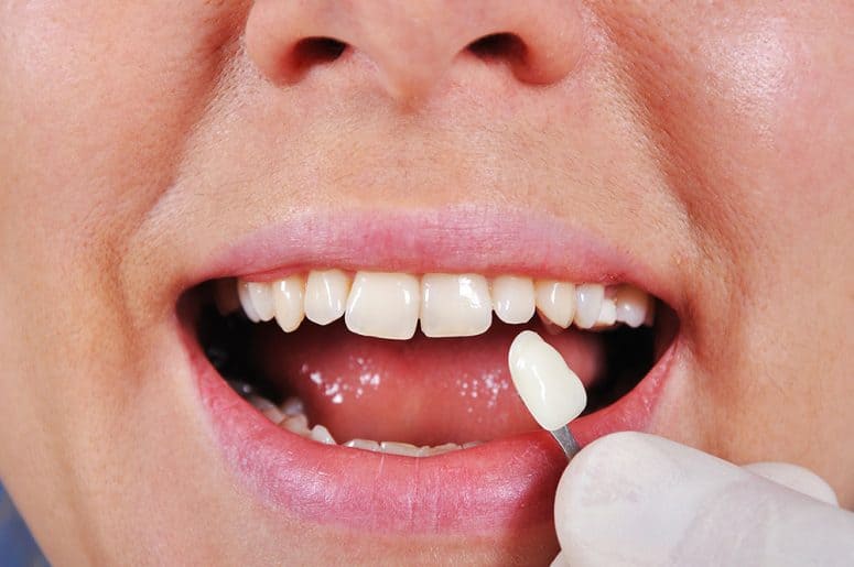 Natural Restoration natural restoration of teeth