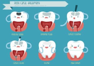 illustration graphic of root canal treatment