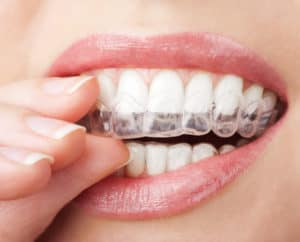 woman using teeth whitening tray
