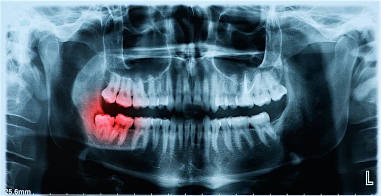 Panoramic x-ray image of teeth and mouth with wisdom teeth